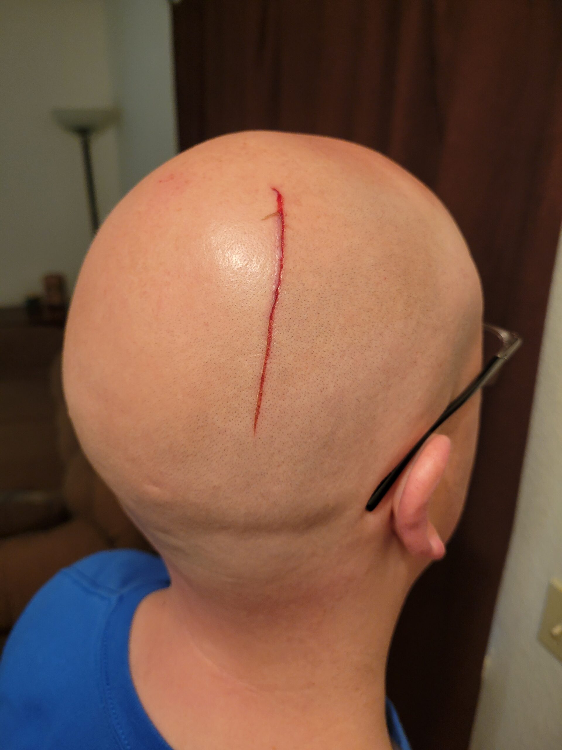 Cut on head from one of the Rav4 hooks